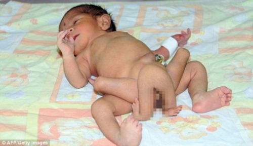 6腿嬰兒